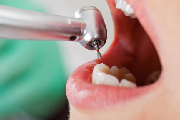 Best Emergency Dental Care for Abscessed Tooth in East Palo Alto, CA